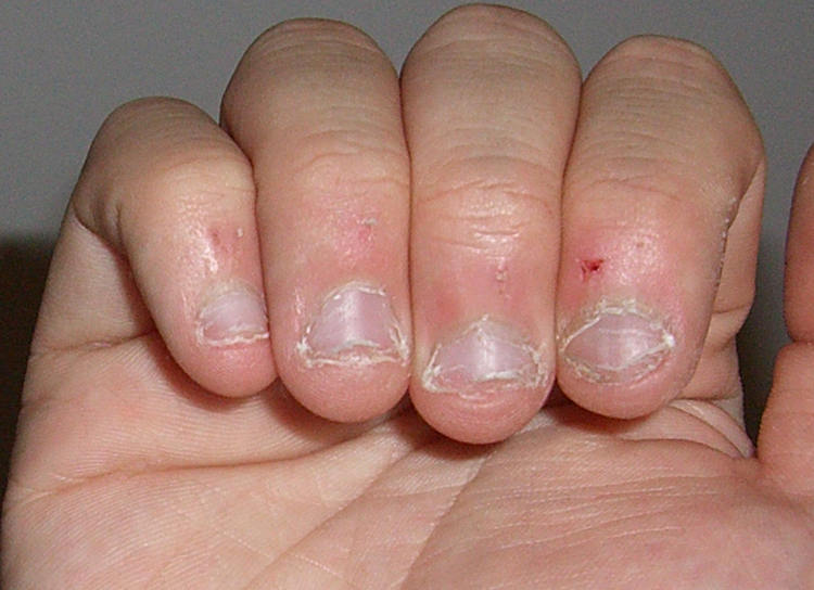 Nailbitebad